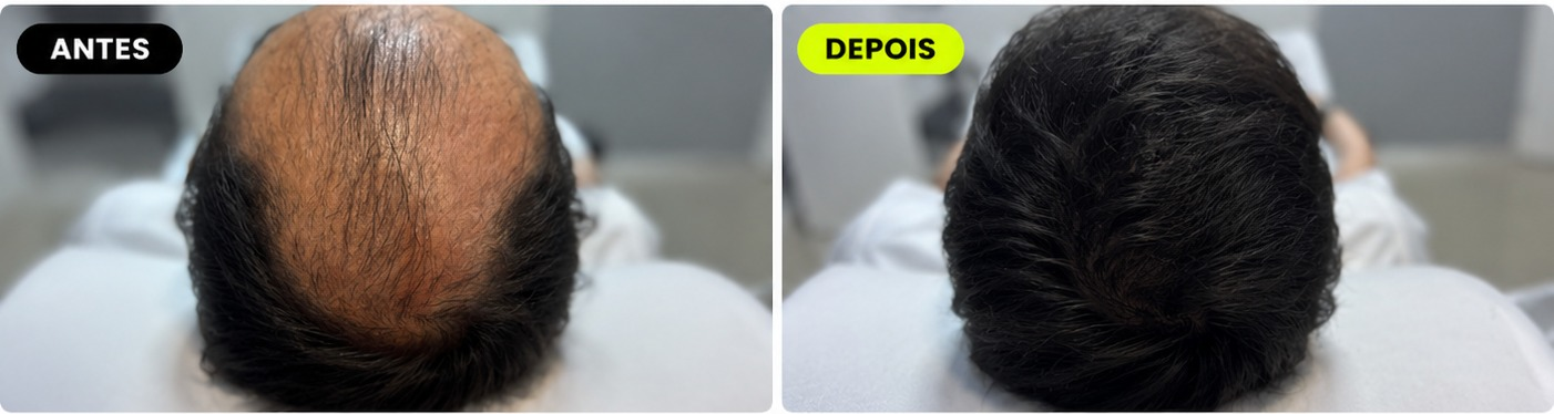 Antes e depois de paciente M Hair